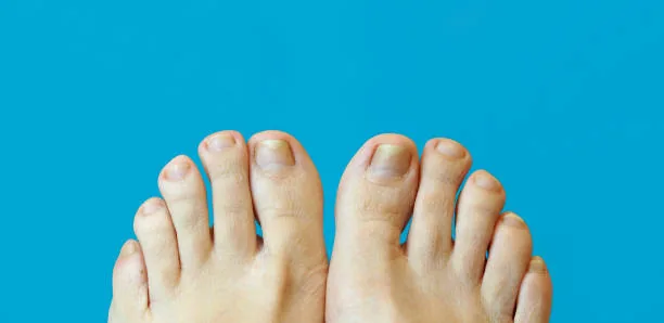 Toenail Fungus & Foot Care